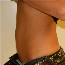 Tummy Tuck After Photo by Steve Laverson, MD, FACS; Rancho Santa Fe, CA - Case 37928