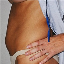 Tummy Tuck Before Photo by Steve Laverson, MD, FACS; Rancho Santa Fe, CA - Case 37928