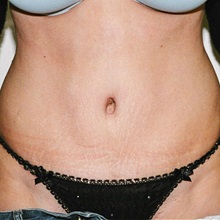 Tummy Tuck After Photo by Steve Laverson, MD, FACS; Rancho Santa Fe, CA - Case 37929