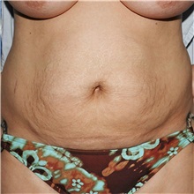 Tummy Tuck Before Photo by Steve Laverson, MD, FACS; Rancho Santa Fe, CA - Case 37929