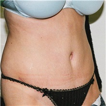 Tummy Tuck After Photo by Steve Laverson, MD, FACS; Rancho Santa Fe, CA - Case 37929