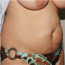 Tummy Tuck Before Photo by Steve Laverson, MD, FACS; Rancho Santa Fe, CA - Case 37929