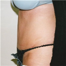 Tummy Tuck After Photo by Steve Laverson, MD, FACS; Rancho Santa Fe, CA - Case 37929