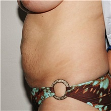 Tummy Tuck Before Photo by Steve Laverson, MD, FACS; Rancho Santa Fe, CA - Case 37929