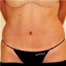 Tummy Tuck After Photo by Steve Laverson, MD, FACS; Rancho Santa Fe, CA - Case 37935