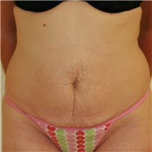 Tummy Tuck Before Photo by Steve Laverson, MD, FACS; Rancho Santa Fe, CA - Case 37935