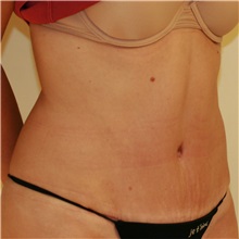 Tummy Tuck After Photo by Steve Laverson, MD, FACS; Rancho Santa Fe, CA - Case 37935