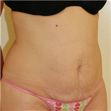 Tummy Tuck Before Photo by Steve Laverson, MD, FACS; Rancho Santa Fe, CA - Case 37935