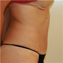 Tummy Tuck After Photo by Steve Laverson, MD, FACS; Rancho Santa Fe, CA - Case 37935