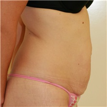 Tummy Tuck Before Photo by Steve Laverson, MD, FACS; Rancho Santa Fe, CA - Case 37935