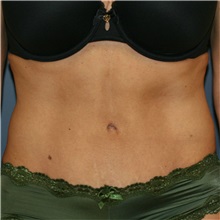 Tummy Tuck After Photo by Steve Laverson, MD, FACS; Rancho Santa Fe, CA - Case 37938