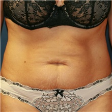 Tummy Tuck Before Photo by Steve Laverson, MD, FACS; Rancho Santa Fe, CA - Case 37938