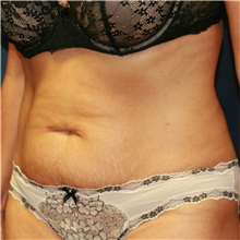 Tummy Tuck Before Photo by Steve Laverson, MD, FACS; Rancho Santa Fe, CA - Case 37938