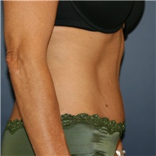 Tummy Tuck After Photo by Steve Laverson, MD, FACS; Rancho Santa Fe, CA - Case 37938