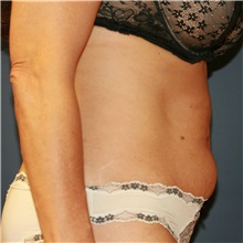 Tummy Tuck Before Photo by Steve Laverson, MD, FACS; Rancho Santa Fe, CA - Case 37938