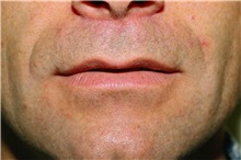 Lip Augmentation/Enhancement After Photo by Steve Laverson, MD, FACS; Rancho Santa Fe, CA - Case 37984