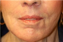 Lip Augmentation/Enhancement After Photo by Steve Laverson, MD, FACS; Rancho Santa Fe, CA - Case 38012