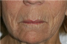 Lip Augmentation/Enhancement Before Photo by Steve Laverson, MD, FACS; Rancho Santa Fe, CA - Case 38012