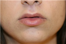 Lip Augmentation/Enhancement After Photo by Steve Laverson, MD, FACS; Rancho Santa Fe, CA - Case 38014