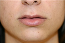 Lip Augmentation/Enhancement Before Photo by Steve Laverson, MD, FACS; Rancho Santa Fe, CA - Case 38014