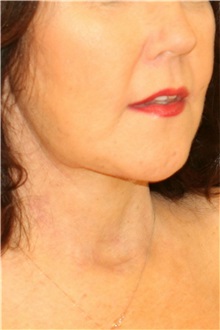 Neck Lift After Photo by Steve Laverson, MD, FACS; Rancho Santa Fe, CA - Case 38166