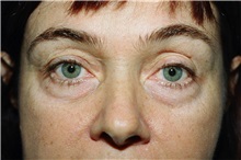 Eyelid Surgery Before Photo by Steve Laverson, MD; San Diego, CA - Case 38168