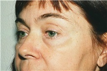 Eyelid Surgery Before Photo by Steve Laverson, MD; San Diego, CA - Case 38168