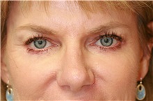 Eyelid Surgery After Photo by Steve Laverson, MD; San Diego, CA - Case 38169