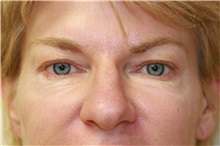 Eyelid Surgery Before Photo by Steve Laverson, MD; San Diego, CA - Case 38169
