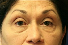 Eyelid Surgery Before Photo by Steve Laverson, MD; San Diego, CA - Case 38178