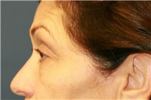 Eyelid Surgery Before Photo by Steve Laverson, MD, FACS; San Diego, CA - Case 38178