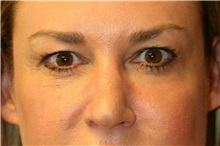 Eyelid Surgery Before Photo by Steve Laverson, MD, FACS; Rancho Santa Fe, CA - Case 38180