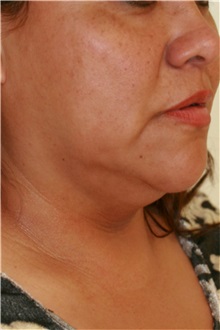 Neck Lift Before Photo by Steve Laverson, MD, FACS; Rancho Santa Fe, CA - Case 38189