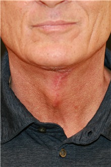 Neck Lift After Photo by Steve Laverson, MD, FACS; Rancho Santa Fe, CA - Case 38190