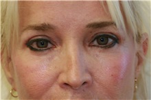 Eyelid Surgery After Photo by Steve Laverson, MD; San Diego, CA - Case 38283