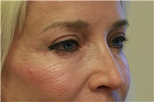 Eyelid Surgery Before Photo by Steve Laverson, MD, FACS; San Diego, CA - Case 38283