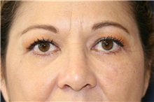 Eyelid Surgery After Photo by Steve Laverson, MD; San Diego, CA - Case 38284