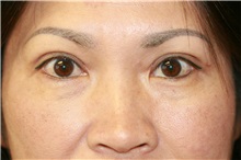 Eyelid Surgery After Photo by Steve Laverson, MD, FACS; Rancho Santa Fe, CA - Case 38320