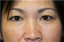 Eyelid Surgery Before Photo by Steve Laverson, MD, FACS; Rancho Santa Fe, CA - Case 38320