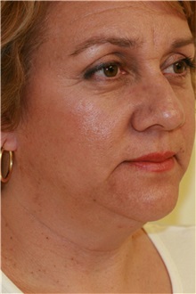 Neck Lift Before Photo by Steve Laverson, MD, FACS; Rancho Santa Fe, CA - Case 38321