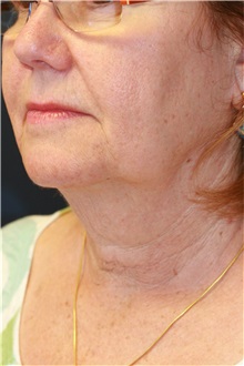 Neck Lift Before Photo by Steve Laverson, MD, FACS; Rancho Santa Fe, CA - Case 38334