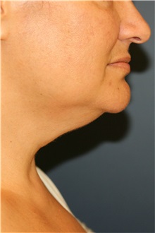 Liposuction Before Photo by Steve Laverson, MD, FACS; Rancho Santa Fe, CA - Case 38347