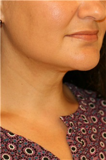 Liposuction After Photo by Steve Laverson, MD, FACS; Rancho Santa Fe, CA - Case 38347