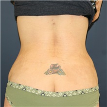 Liposuction After Photo by Steve Laverson, MD, FACS; San Diego, CA - Case 38371