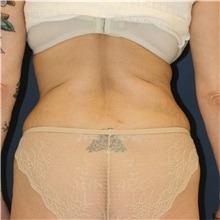 Liposuction Before Photo by Steve Laverson, MD, FACS; San Diego, CA - Case 38371