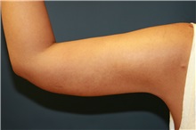 Liposuction After Photo by Steve Laverson, MD, FACS; San Diego, CA - Case 38397