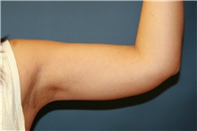 Liposuction After Photo by Steve Laverson, MD, FACS; Rancho Santa Fe, CA - Case 38397