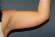 Liposuction Before Photo by Steve Laverson, MD, FACS; Rancho Santa Fe, CA - Case 38397