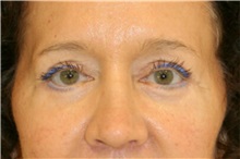Eyelid Surgery After Photo by Steve Laverson, MD; San Diego, CA - Case 38426