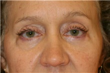 Eyelid Surgery Before Photo by Steve Laverson, MD; San Diego, CA - Case 38426